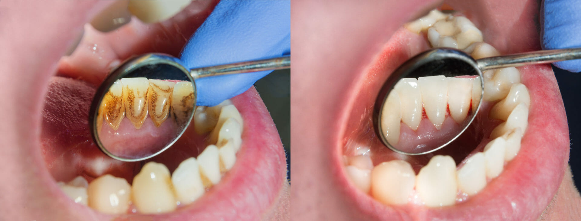 periodontal hygiene - FMS Dental in Houston