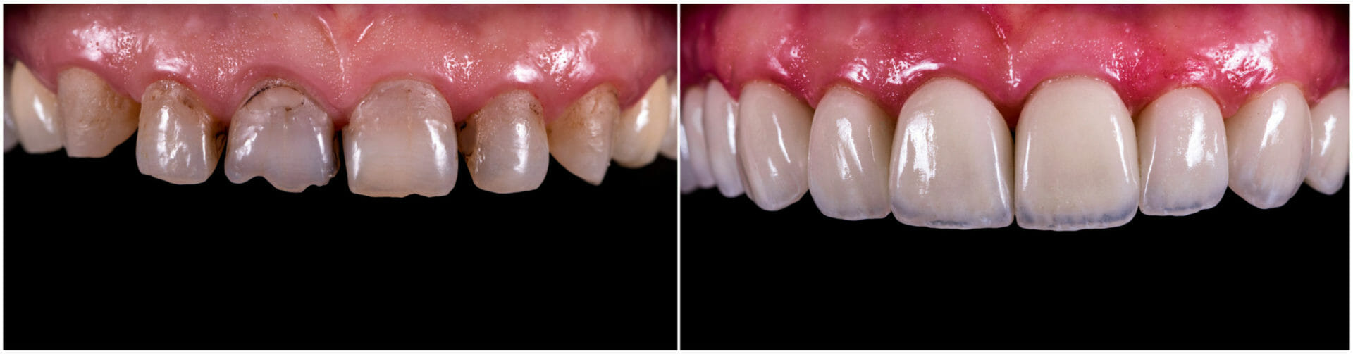 Before and After Dental Crowns