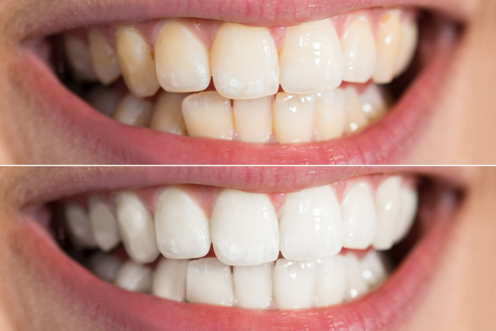 Before and After KÖR TEETH WHITENING​​