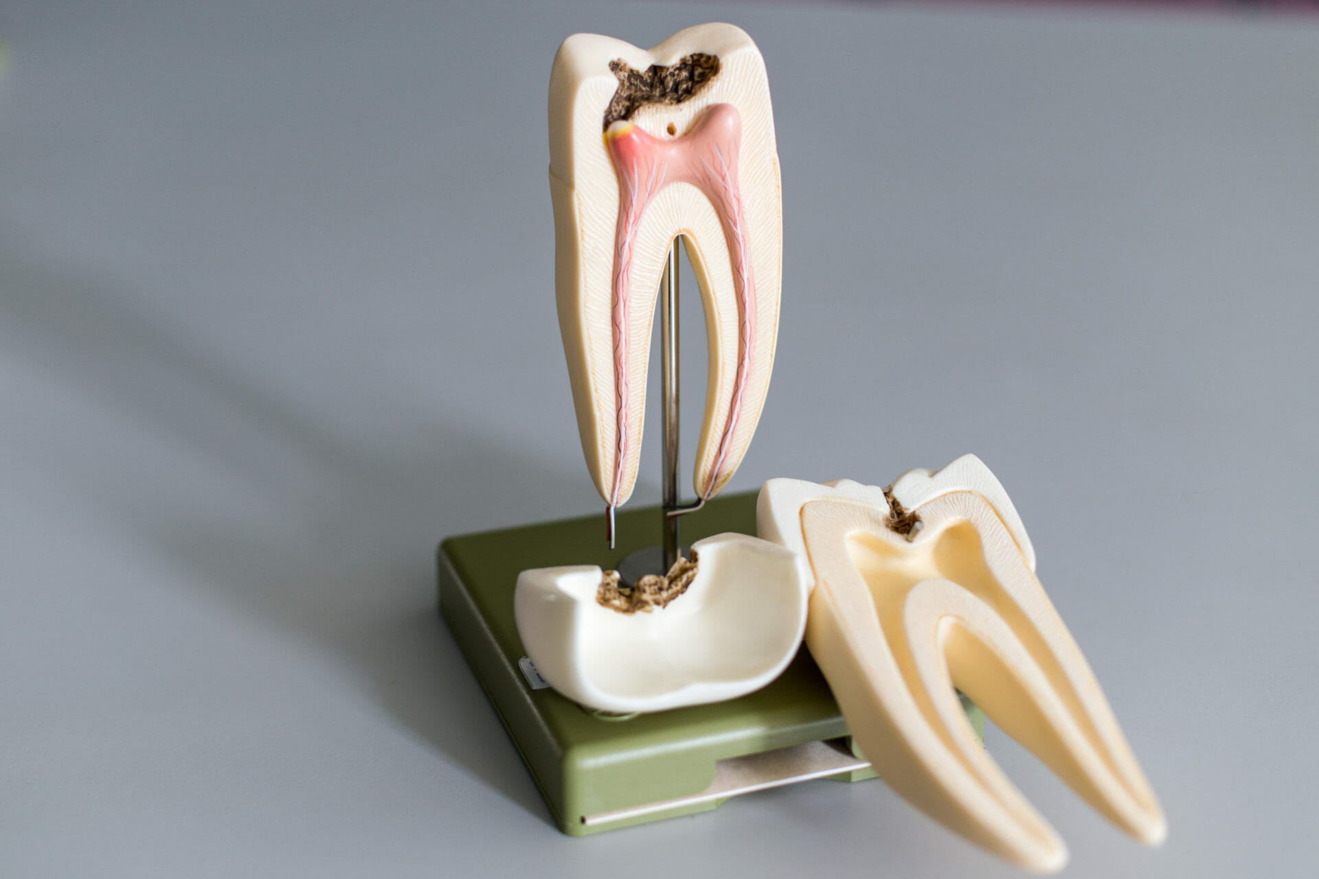 root canal therapy in houston - fms dental