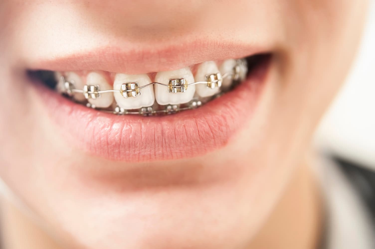traditional bracket braces - houston orthodontists - fms dental