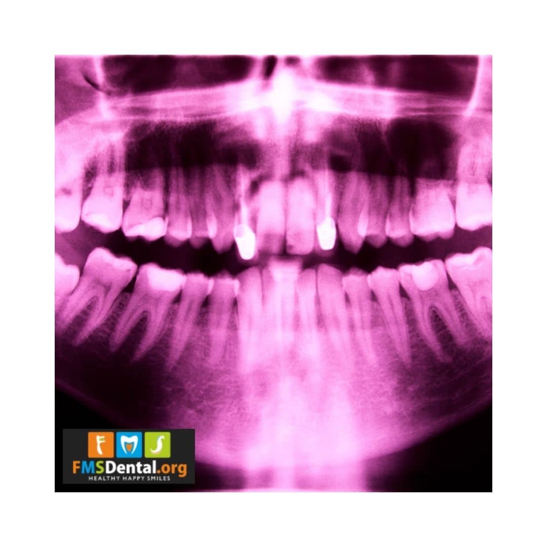 Read more about the article Oral Health and the Benefit of Dental X-rays
