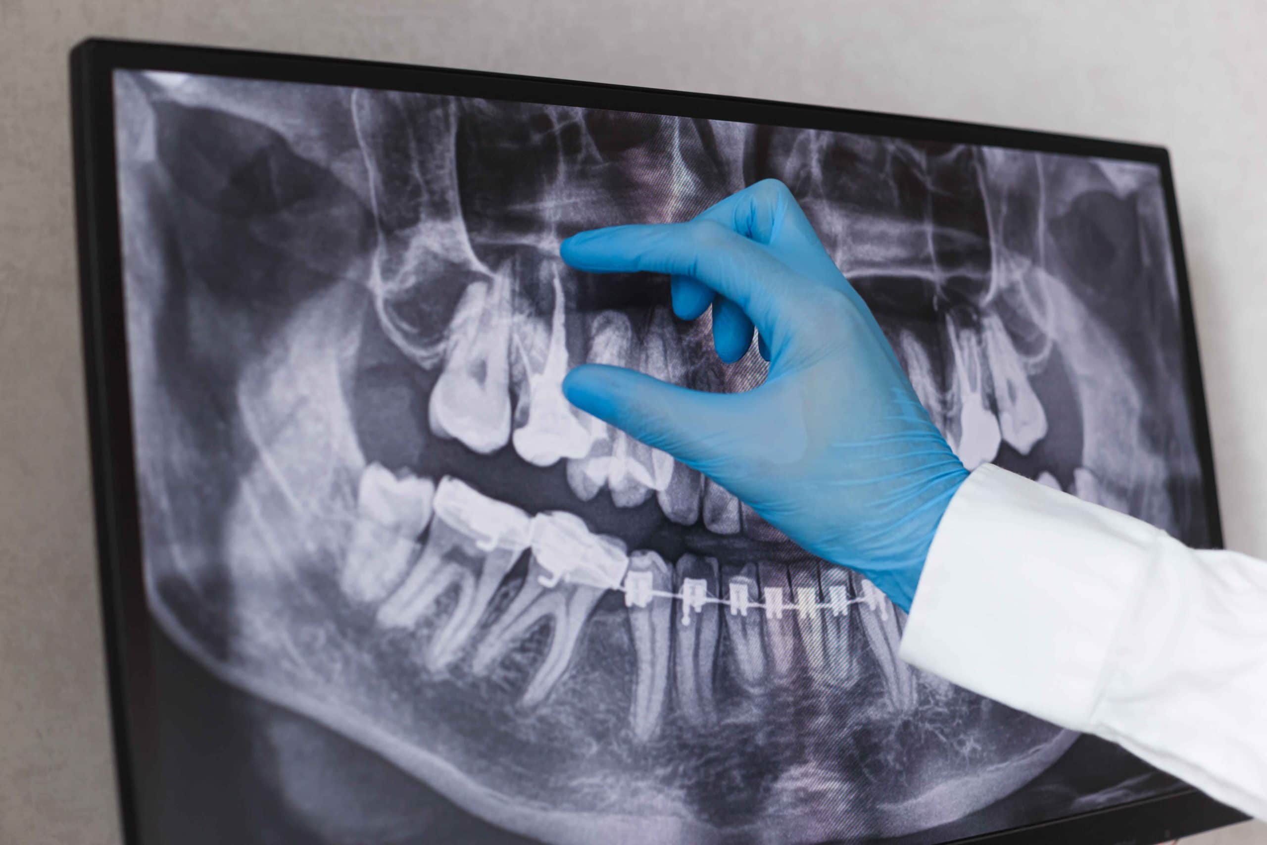 Read more about the article Root Canal Therapy: What to Expect