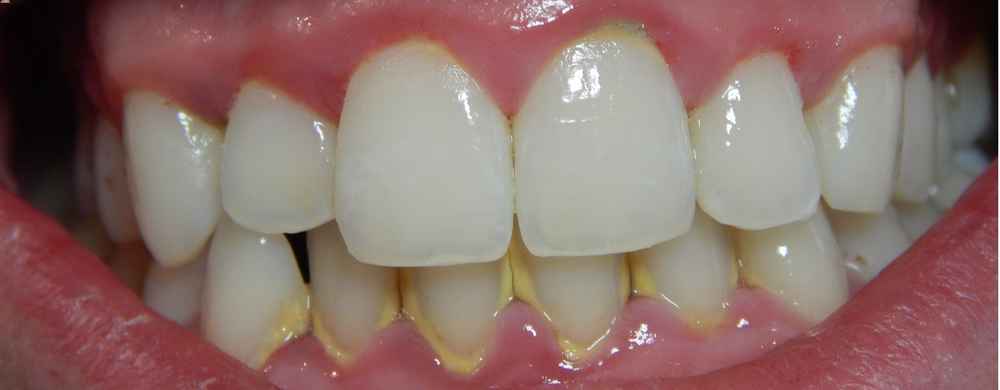 Read more about the article Gingivitis: What to Know – Causes, Symptoms, and More