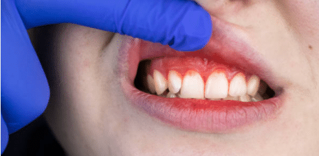 Read more about the article Untreated Gum Disease: 6 Dangers