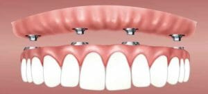 Read more about the article How to Care for Dental Implants