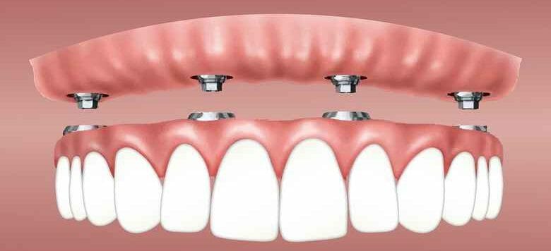 Read more about the article How to Care for Dental Implants
